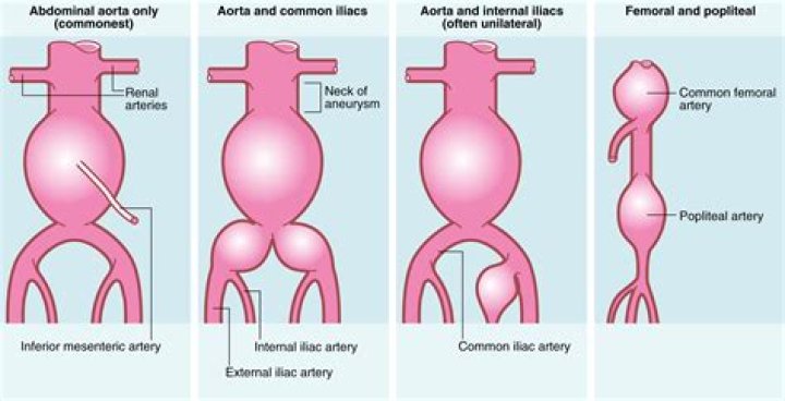 Can a CT scan show an unruptured aneurysm?