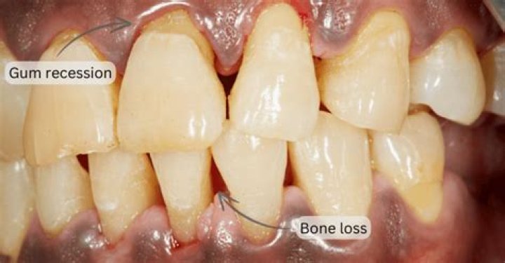 Can bone calcification be reversed