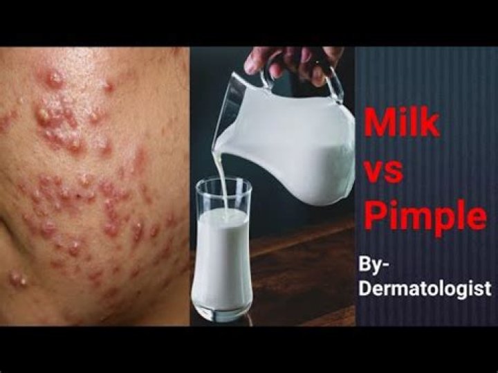 Can drinking milk cause acne?