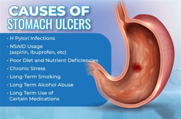 Can you be hospitalized for stomach ulcers