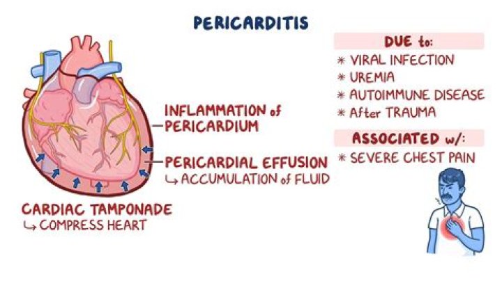 Can you feel pericardial rub?