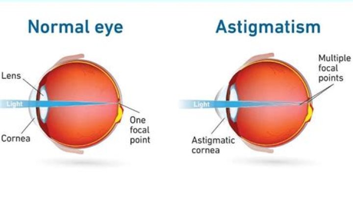 Can your astigmatism axis change?