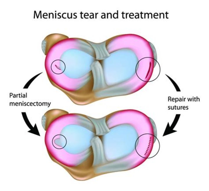 Do radial meniscus tears require surgery?