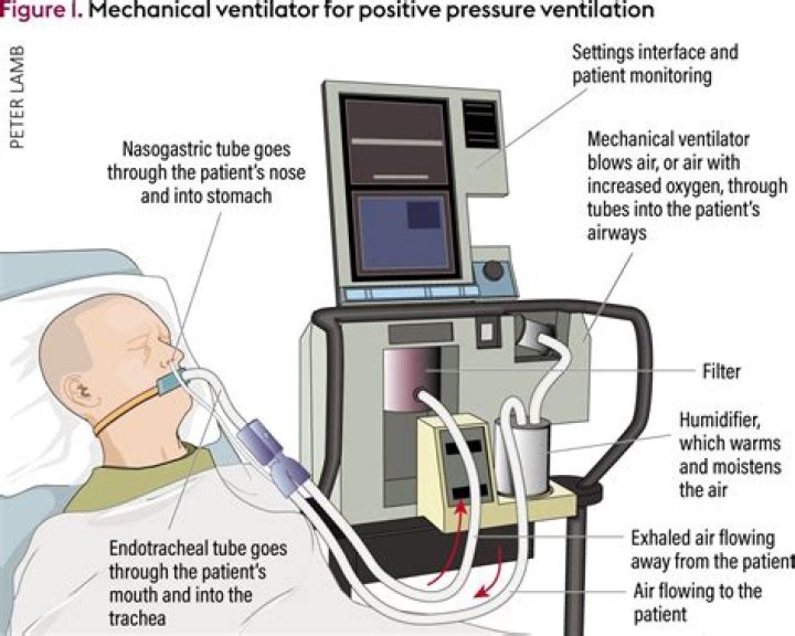 Does a tracheostomy replace a ventilator