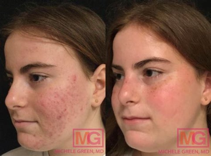 Does accutane get rid of acne scars?