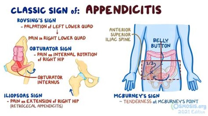 Does appendicitis have rebound tenderness