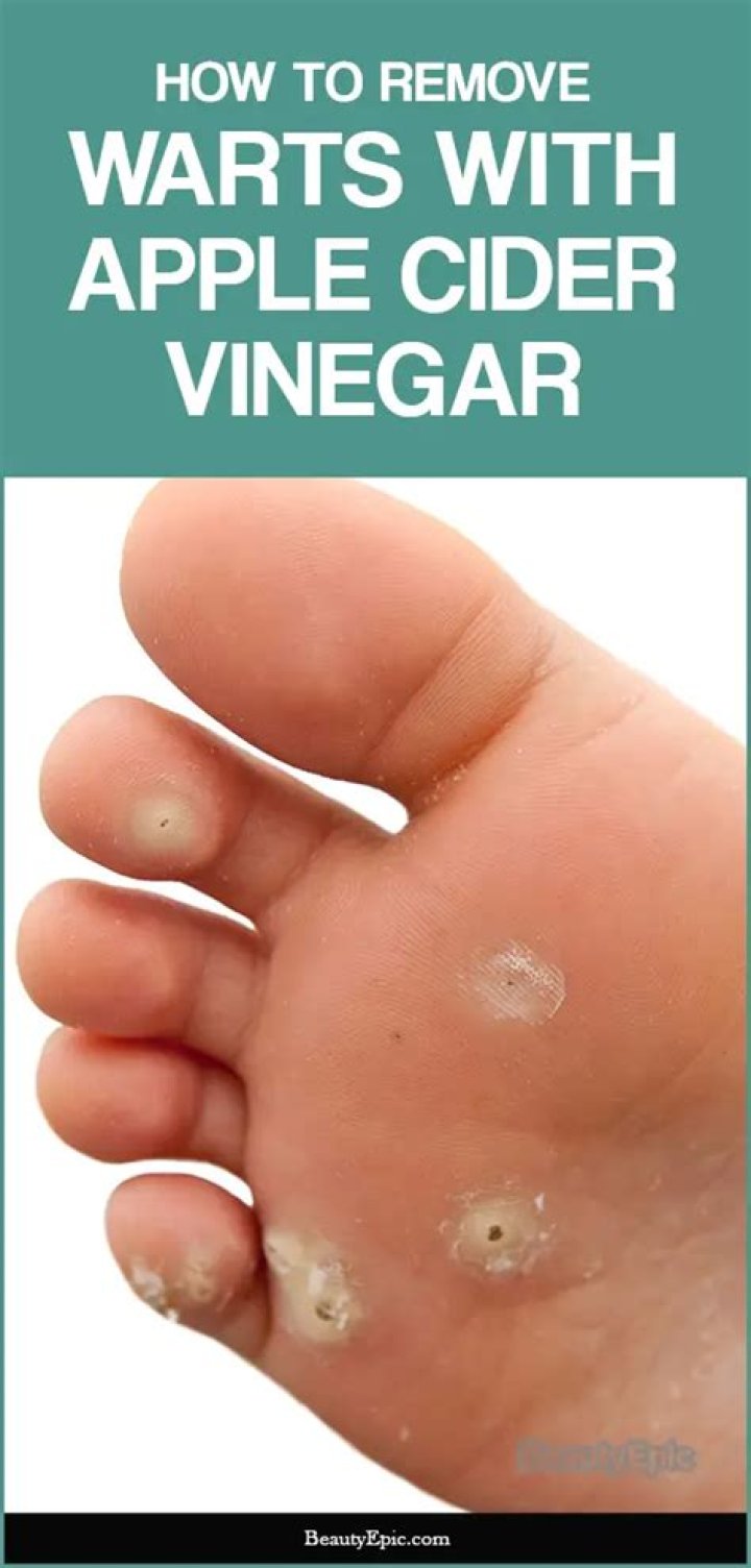 Does apple cider vinegar remove plantar warts?