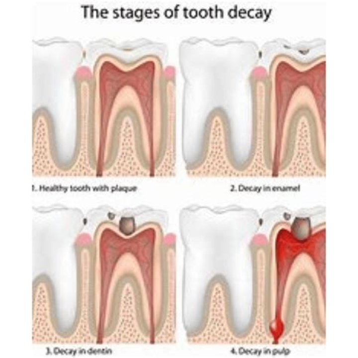 Does capping teeth prevent cavities?