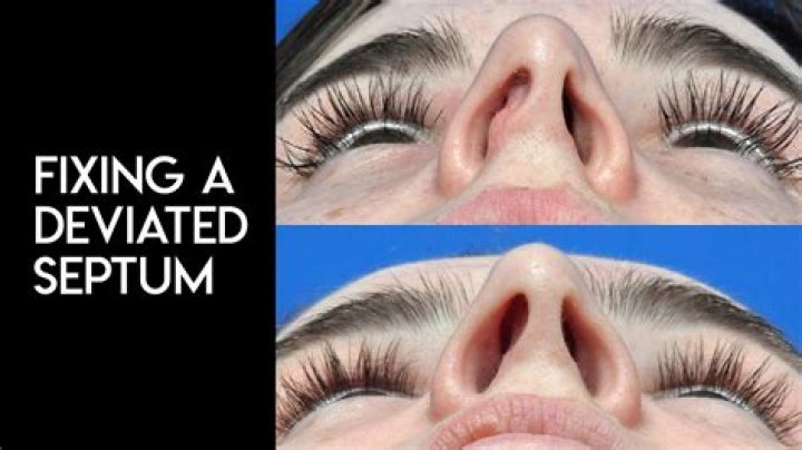 Does fixing a deviated septum change the appearance of your nose