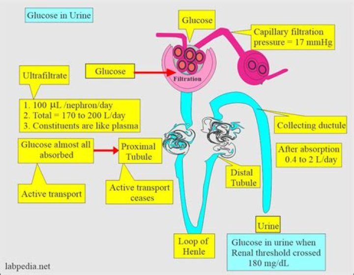 Does glucose in urine always mean diabetes?