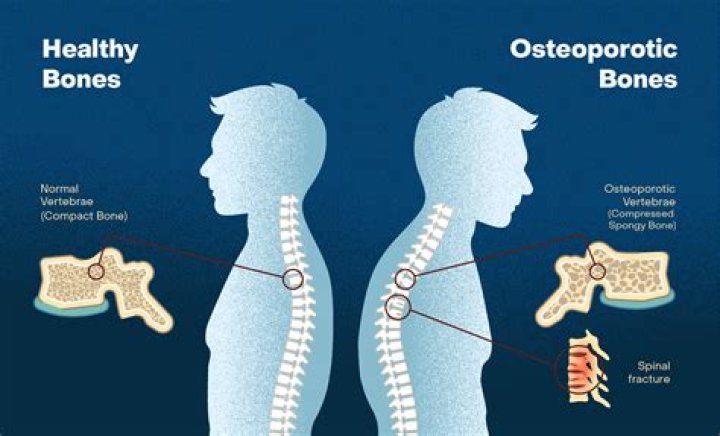 Does Strontium help osteoporosis