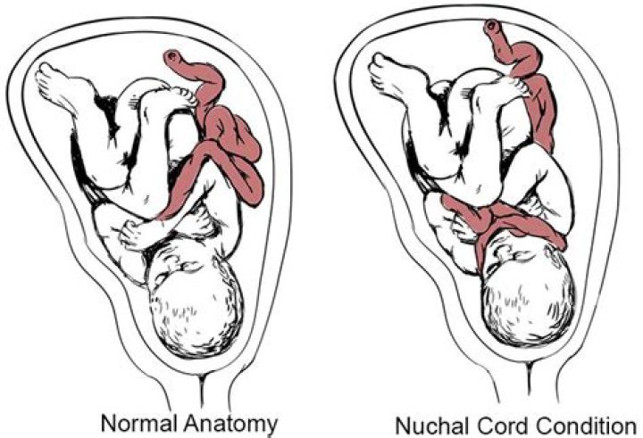 Does tight nuchal cord mean compression