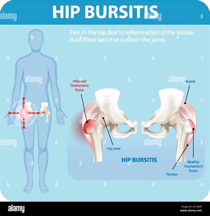 How can I treat hip bursitis at home?