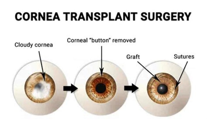 How cornea transplant is done?