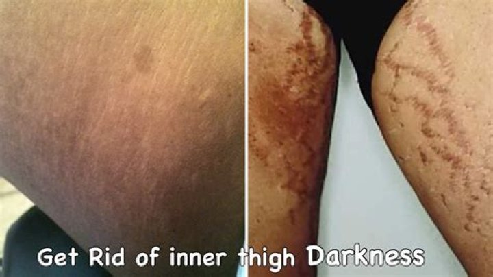 How do I get rid of the darkness between my legs?