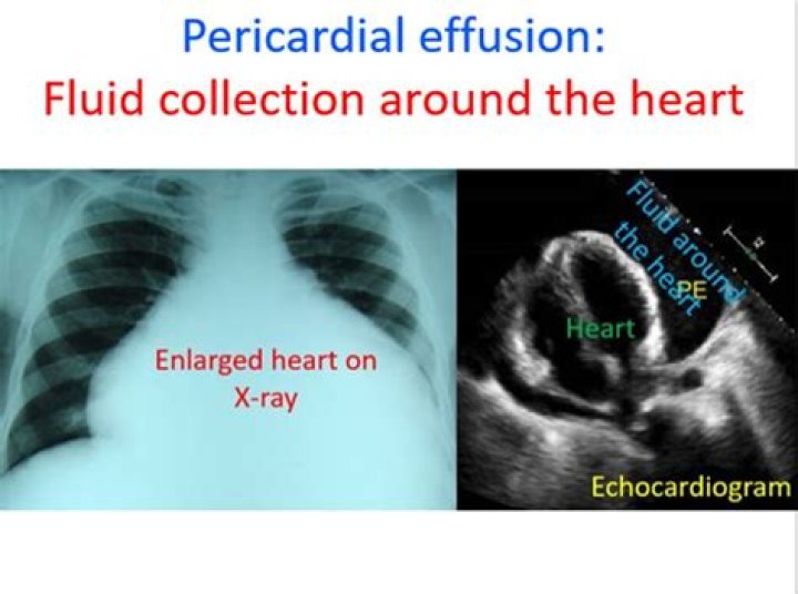 How do you fix a pericardial effusion