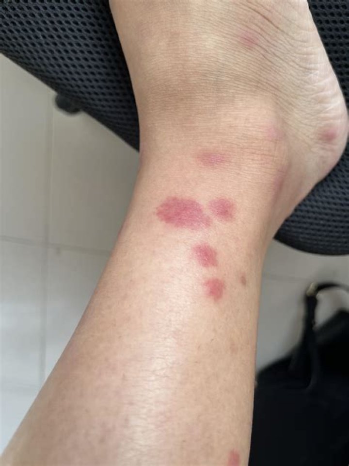 How do you fix bite marks on walls?