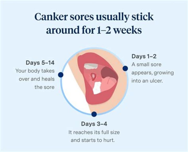 How do you get rid of canker sores on your tongue?