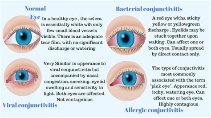 How do you prevent eye infections?