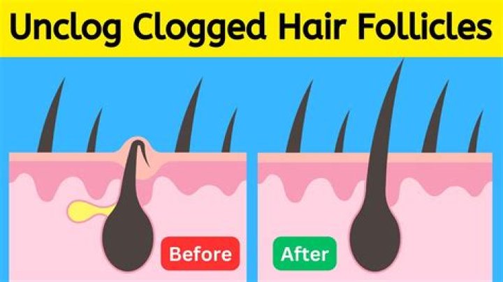 How do you treat clogged hair follicles?