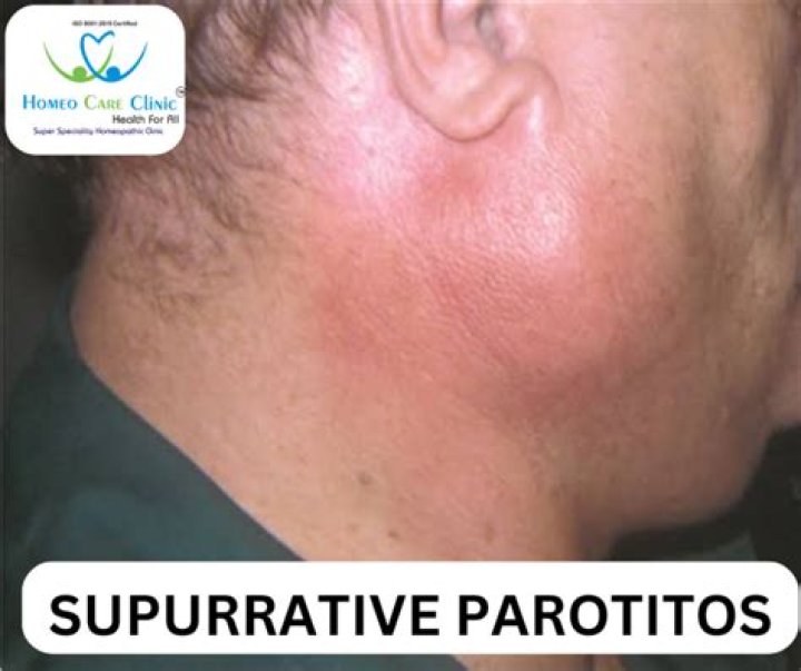 How do you treat parotitis at home