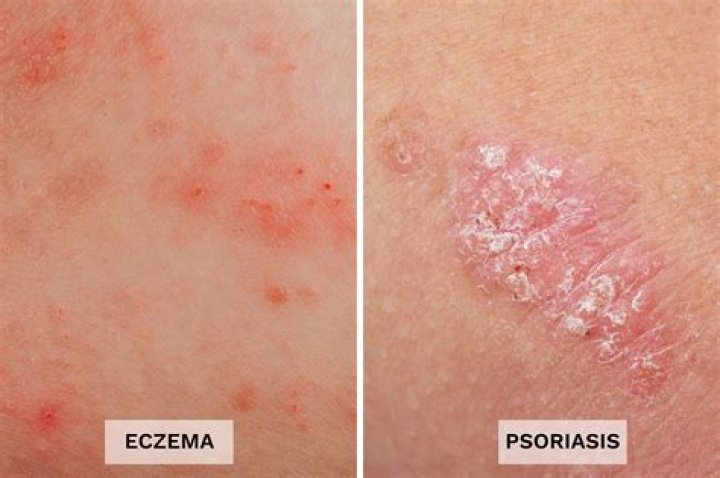How does eczema Herpeticum start