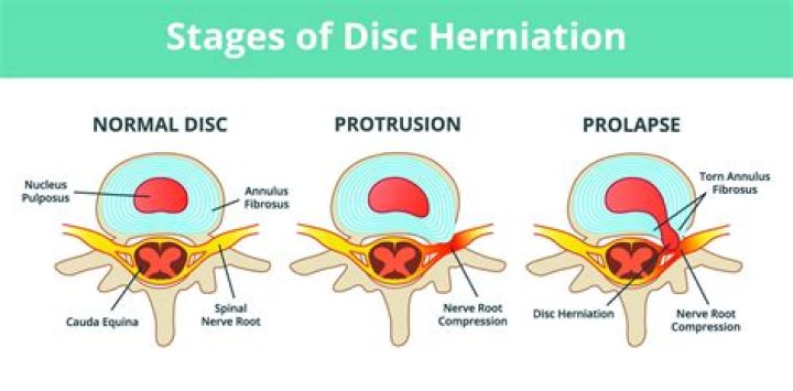 How is a herniated nucleus pulposus diagnosed