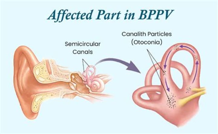 How is provoked Vestibulodynia treated?