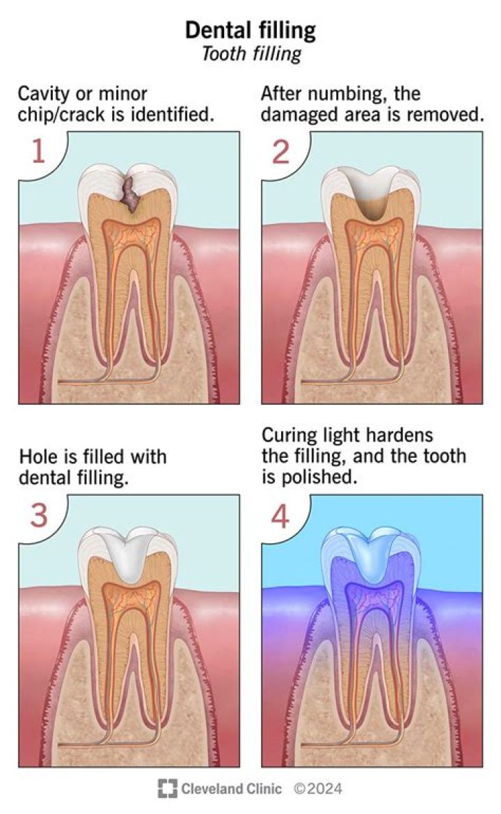 How long can dental filling last?