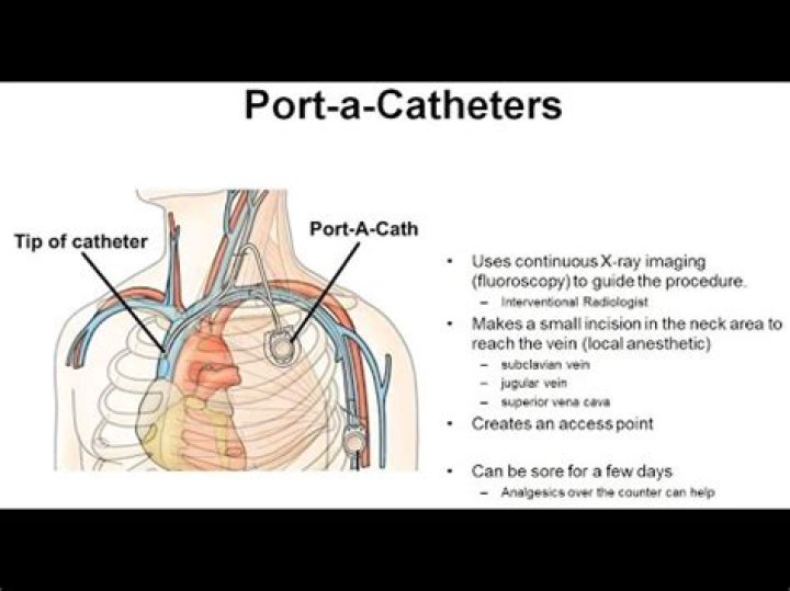 How long can port a cath stay in