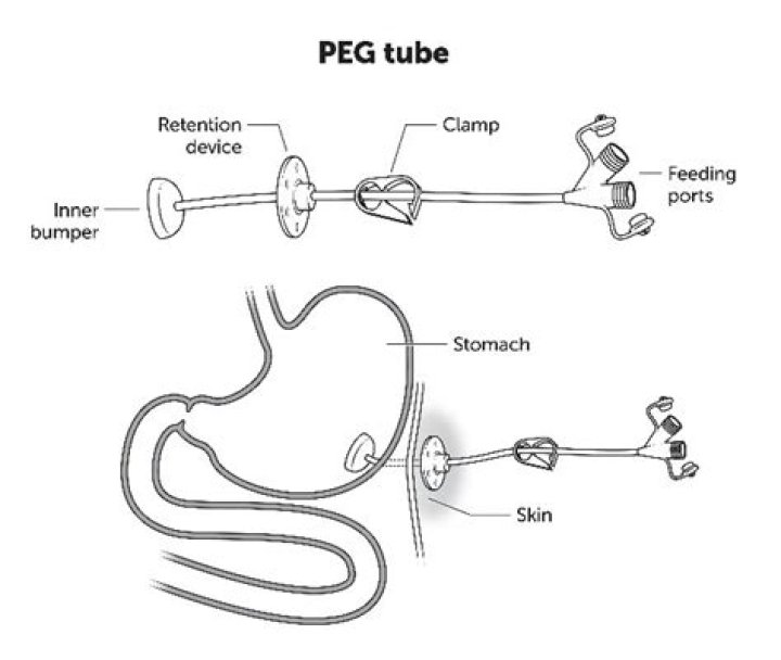How much residual is normal for PEG tube?
