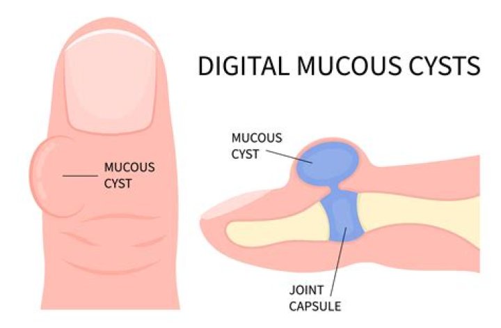 Is a mucous cyst the same as a ganglion cyst