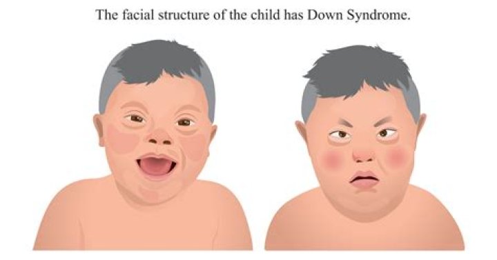 Is Down Syndrome capitalized? | ContextResponse.com