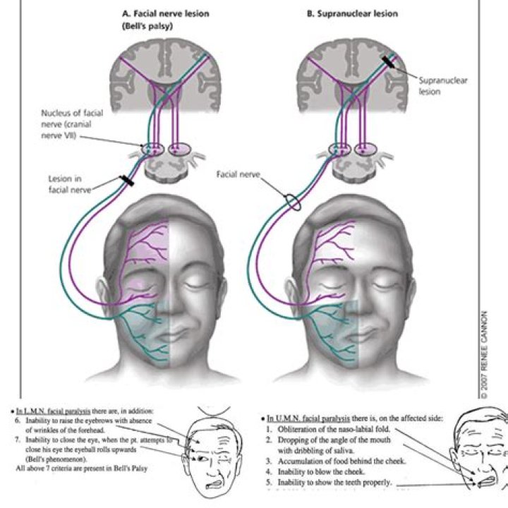 Is facial droop ipsilateral or contralateral