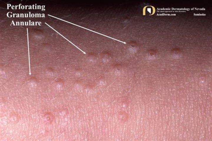 Is granuloma annulare fungal