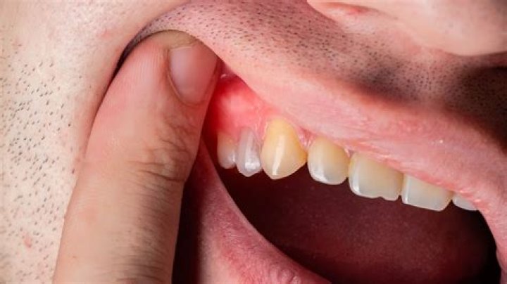 Is it OK to put ice on an abscess?