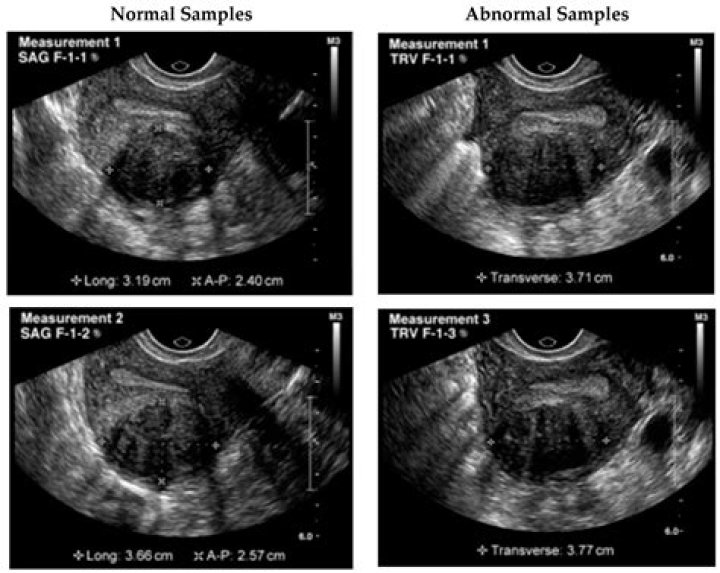 Is normal uterus palpable?