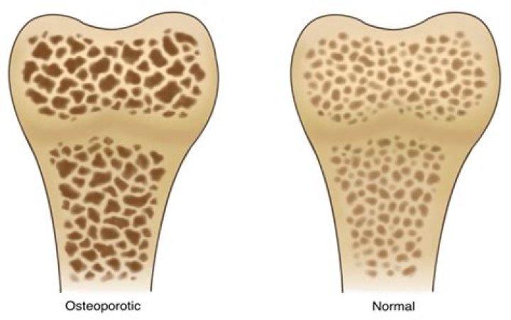 Is osteoporosis an orthopedic condition?