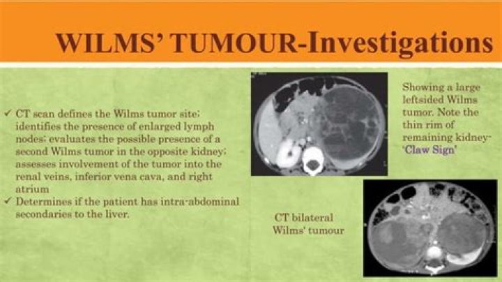 Is Wilms tumor malignant