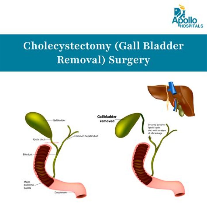 Is wine good for gallbladder?