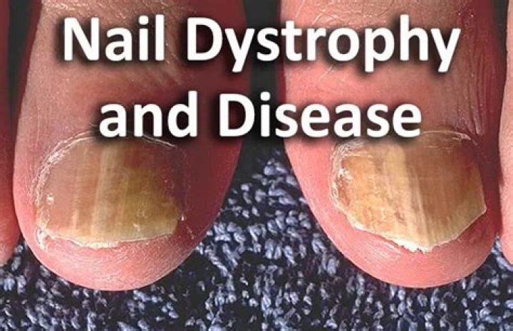 What are dystrophic nails