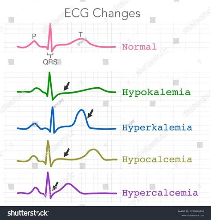 What are the ECG changes associated with pain in a patient with angina pectoris