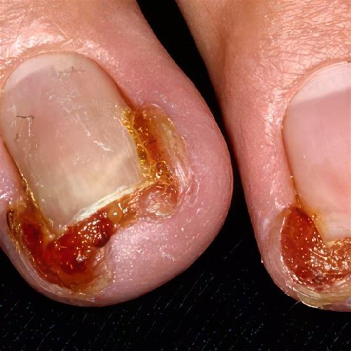 What are the other diseases of the nail?