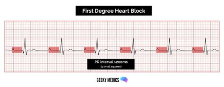 What are the symptoms of first degree heart block