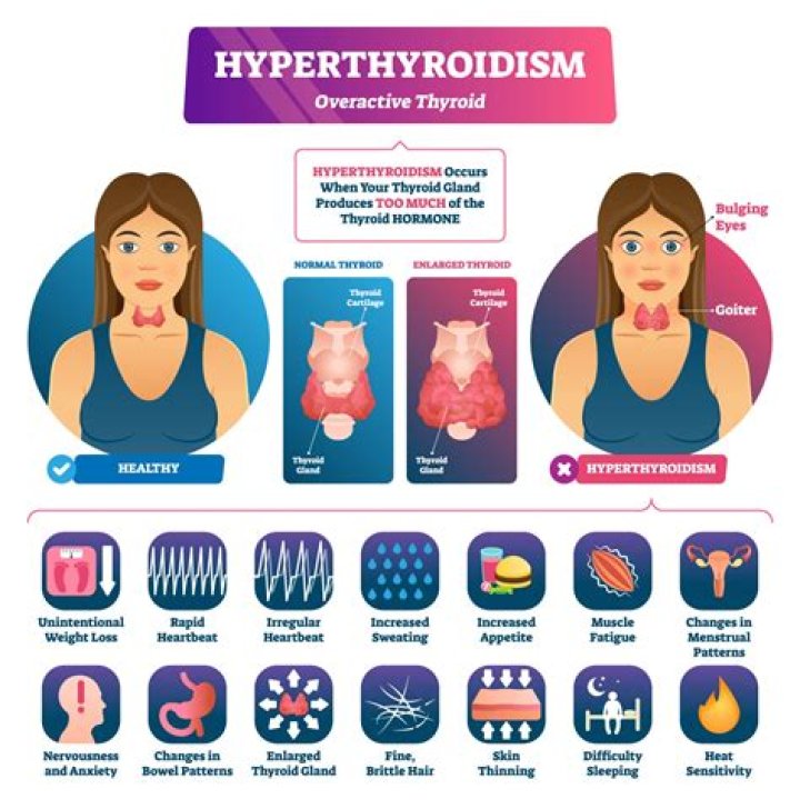 What are the types of hyperthyroidism