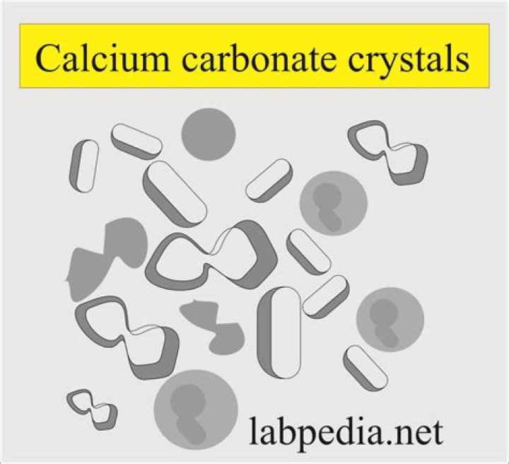 What causes calcium carbonate crystals in urine?