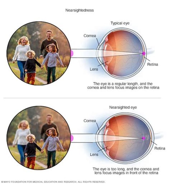 What causes child nearsightedness?