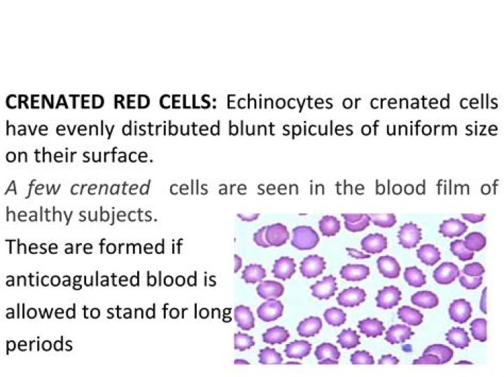 What causes Crenated red blood cells