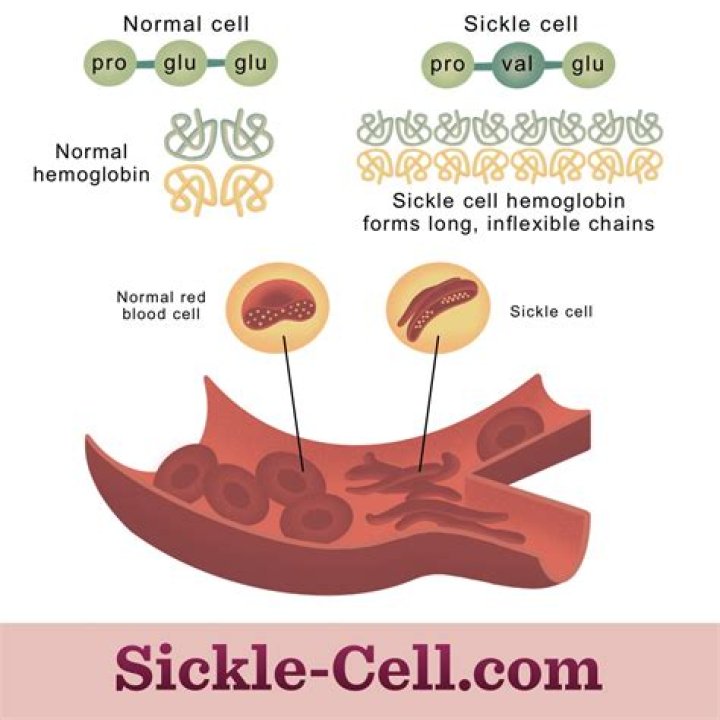 What DNA changes produce sickle cell hemoglobin