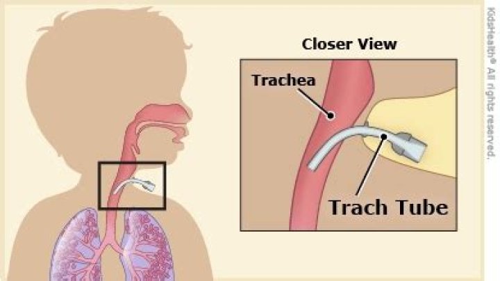 What does a tracheal tug indicate